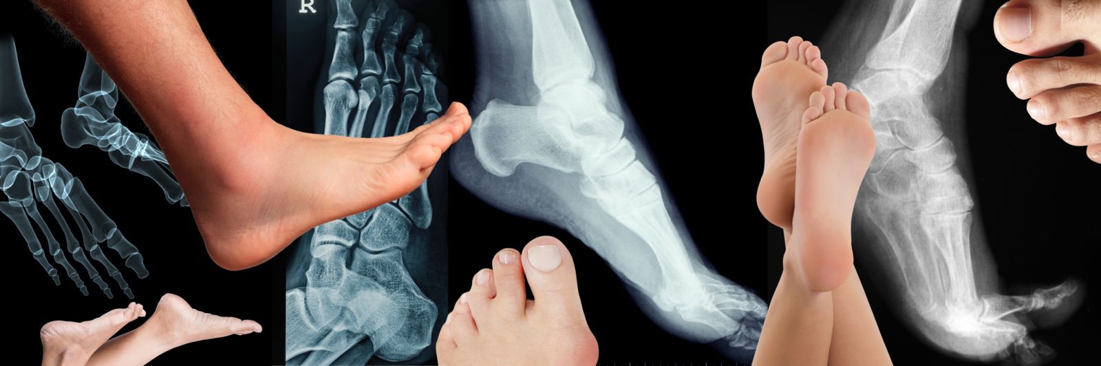 Common Deformities of the Feet Sol Foot & Ankle Centers